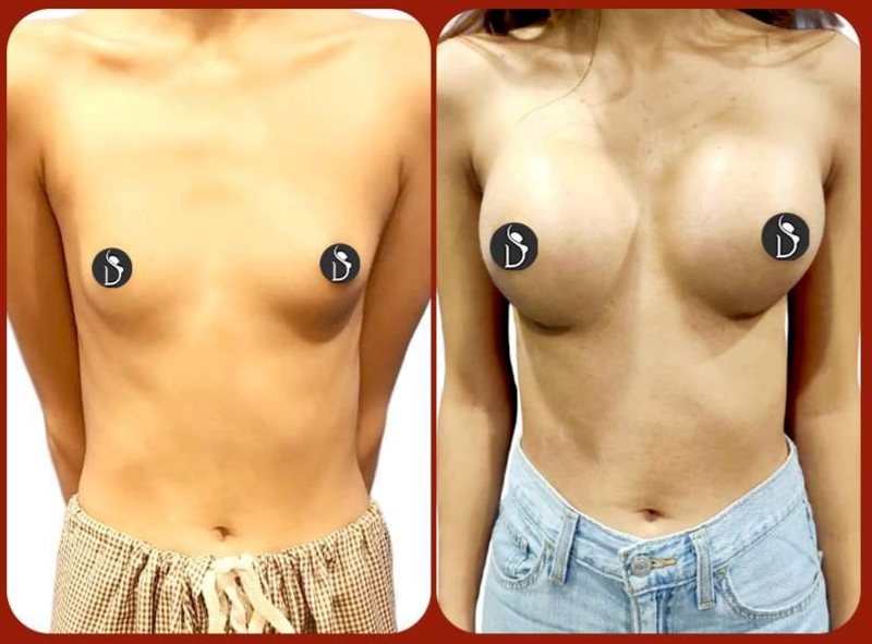 Before and after: Breast Augmentation