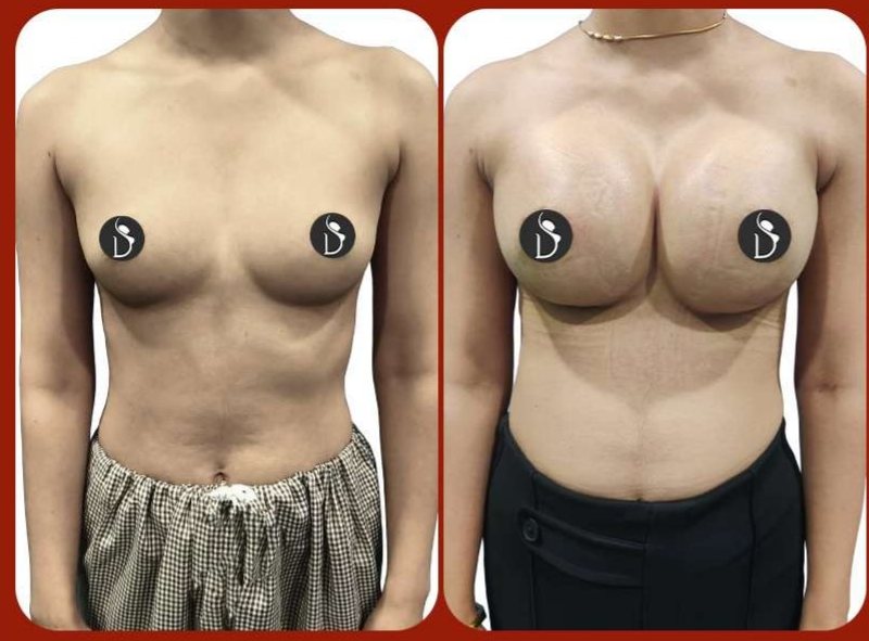 Before and after: Breast Augmentation