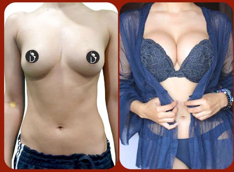 Before and after: Breast Augmentation