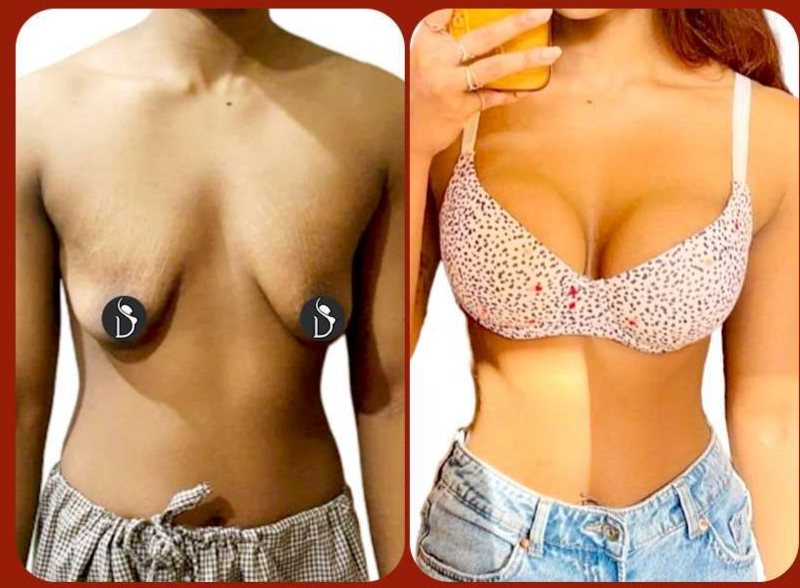 Before and after: Breast Augmentation