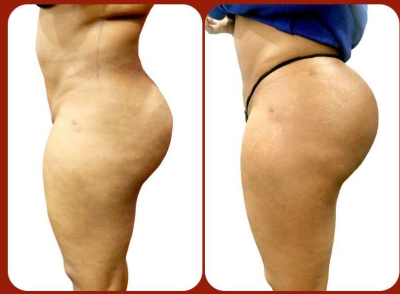 Before and after: Butt Augmentation