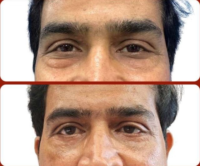 Before and after: Lower Eyelid Surgery