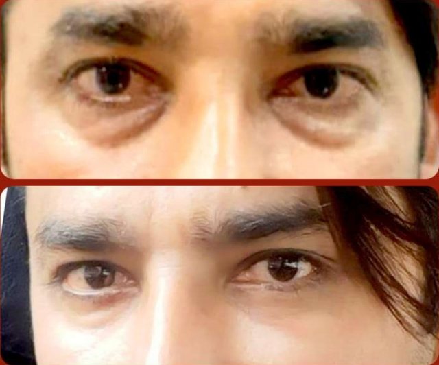 Before and after: Lower Eyelid Surgery