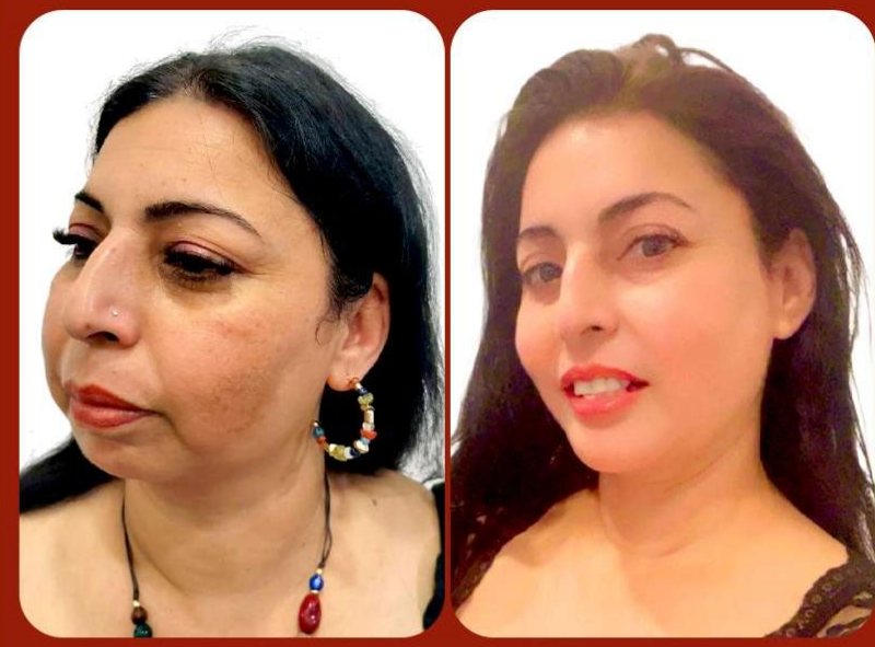 Before and after: Facial Rejuvenation