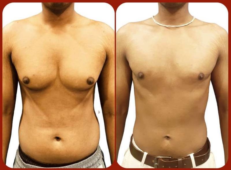 Before and after: Gynecomastia Treatment (Grade 2A)