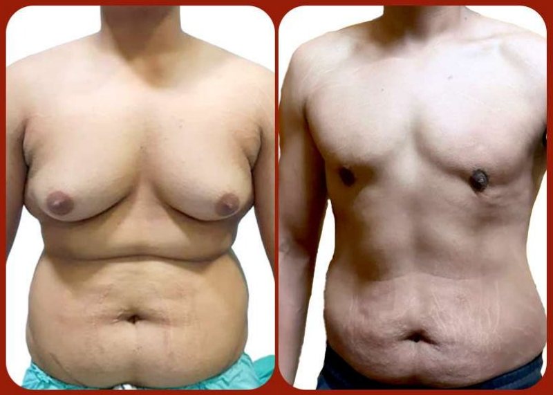 Before and after: Gynecomastia Treatment (Grade 4A)