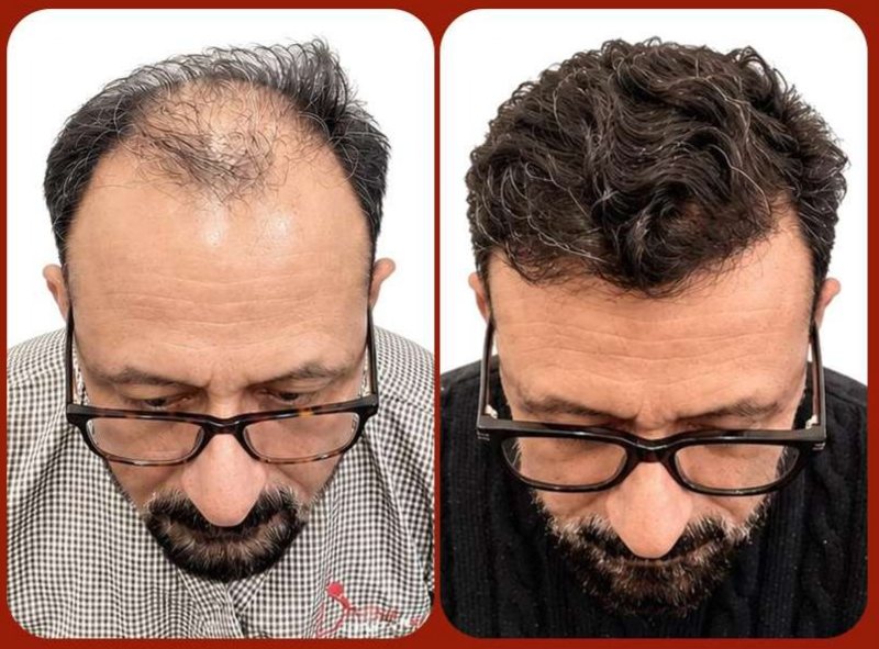 Before and after: Hair Transplant