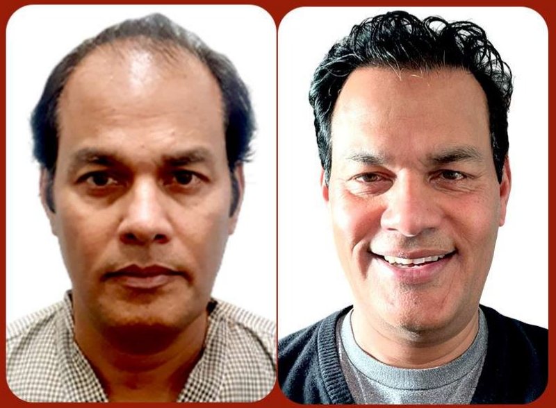 Before and after: Long Hair Transplant