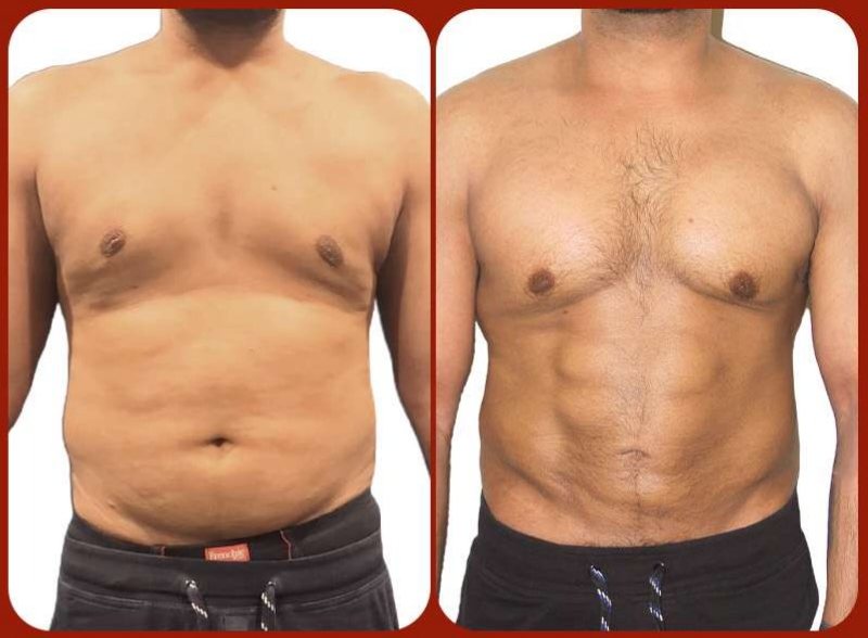 Before and after: Male Body Contouring