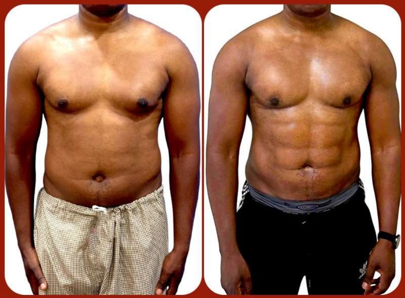 Before and after: Male Body Contouring