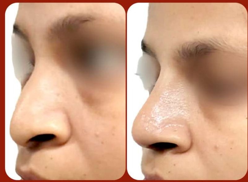 Before and after: Rhinoplasty
