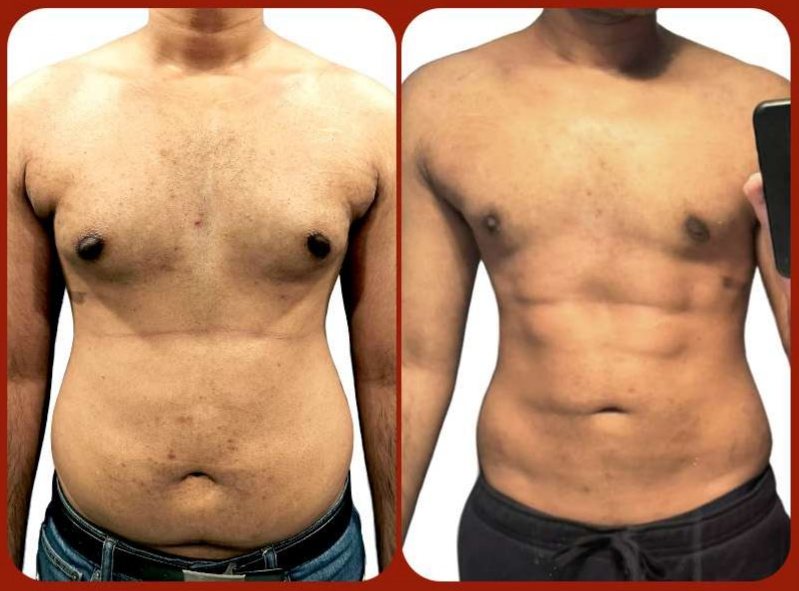 Before and after: Six-Pack Abs + Gyno Treatment