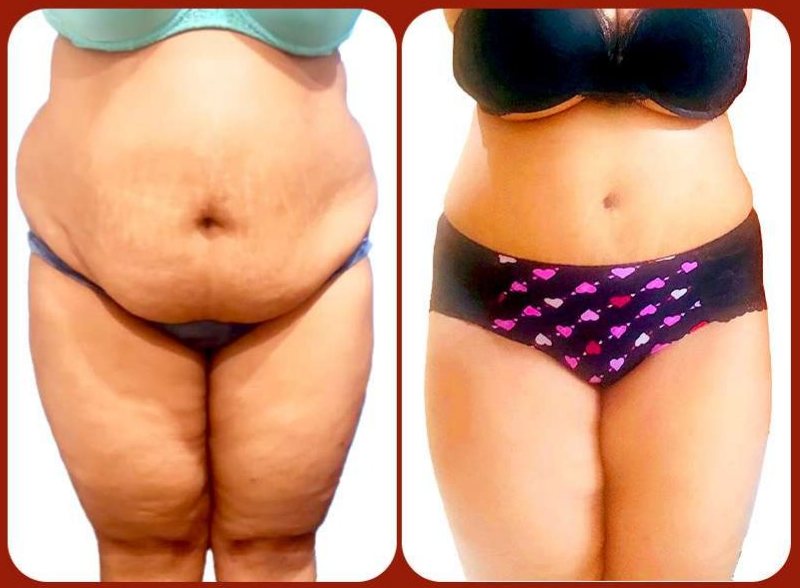 Before and after: Tummy Tuck