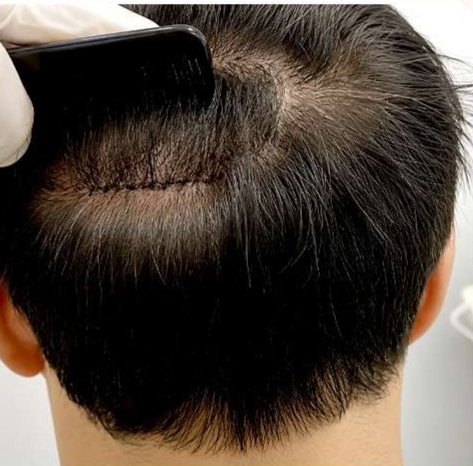 FUT Hair Transplant