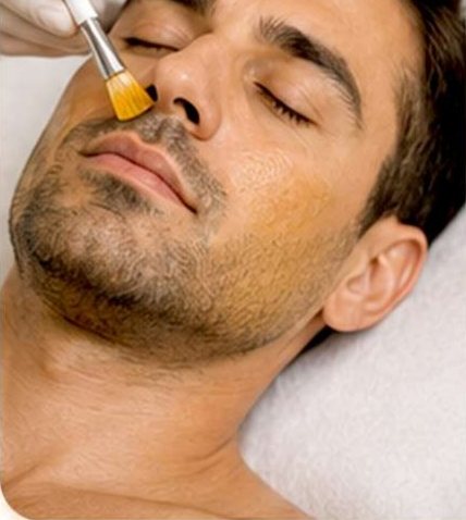 Chemical Peels