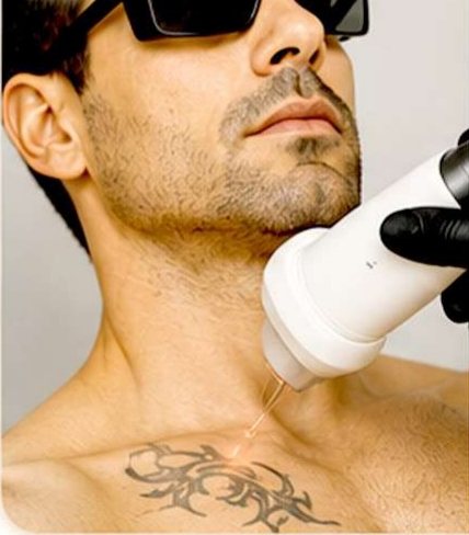 Tattoo Removal
