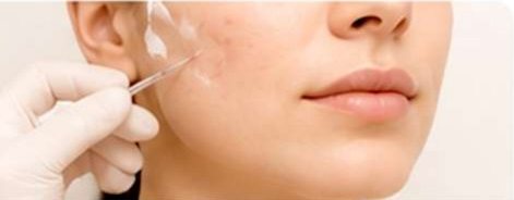 Acne Scar Treatment