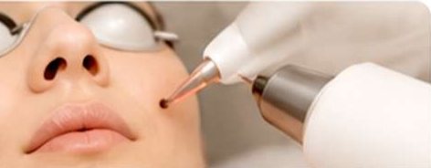 Pigmentation & Mole Removal