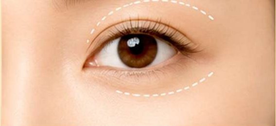 Blepharoplasty (Eyelid Surgery)
