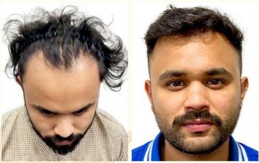 Before and after: Hair Transplant (Bhaskar)