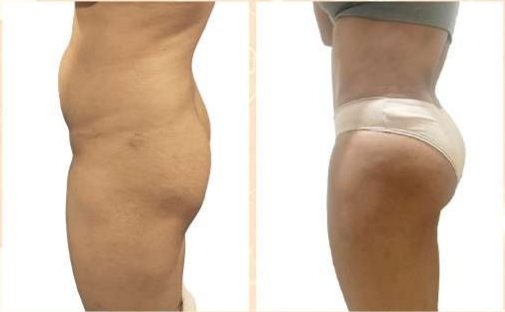 Before and after: Butt Implants (Deepa)