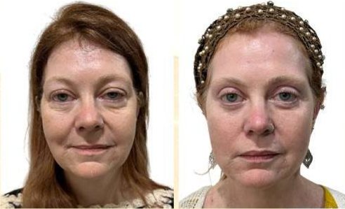 Before and after: Infinite Thread Lift (Kylee)