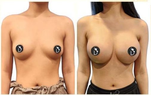 Before and after: Breast Implants (Meenakshi)