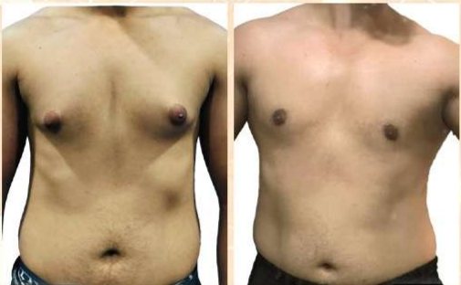 Before and after: Gynecomastia Treatment (Rajesh)