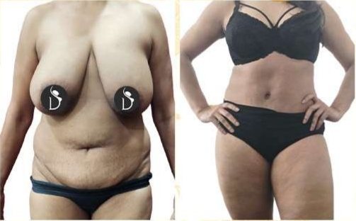 Before and after: Mommy Makeover (Sheetal)