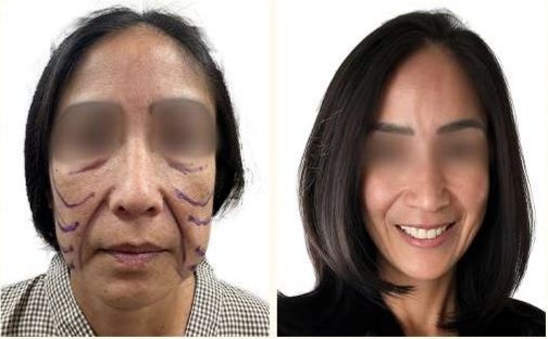Before and after: Infinite Thread Lift (Sheetal)