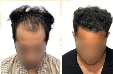 Before and after: Long Hair Transplant (Sidhant)