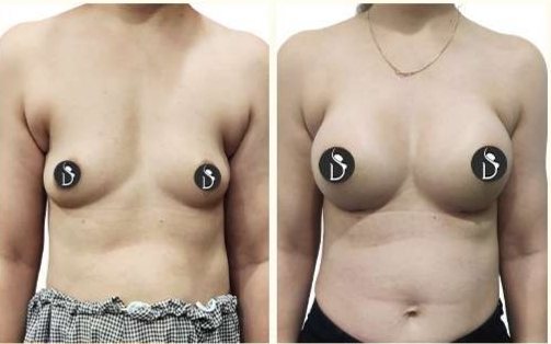 Before and after: Breast Implants (Suchita)