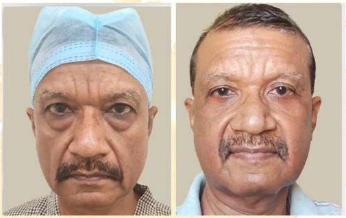 Before and after: Blepharoplasty (Sunil)